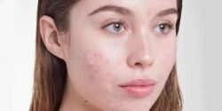 تعبیر خواب جوش صورت ابن سیرین و حضرت یوسف و امام صادق جوش صورت دیگری