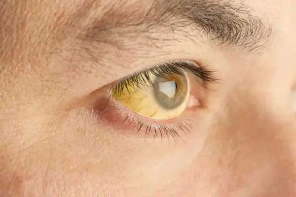 تعبیر خواب چشم زرد برای زن متاهل و باردار و دختر مجرد از روانشناسی
