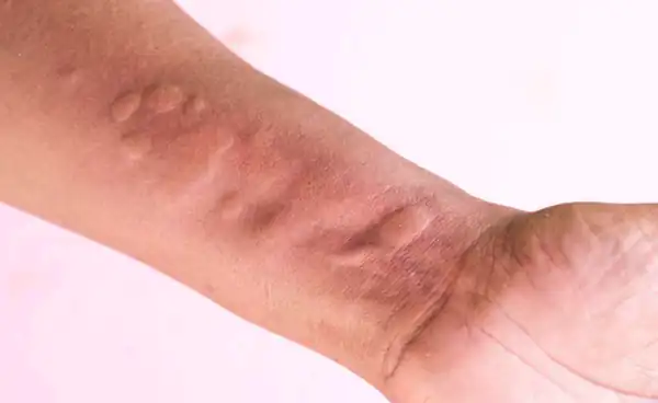 تعبیر خواب کهیر زدن برای زن متاهل و باردار و دختر مجرد از روانشناسی