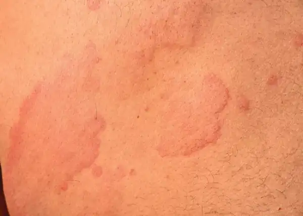 تعبیر خواب کهیر زدن بدن برای زن متاهل و باردار و دختر مجرد از روانشناسی