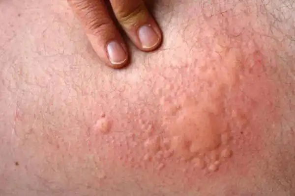 تعبیر خواب کهیر زدن کل بدن برای زن متاهل و باردار و دختر مجرد از روانشناسی