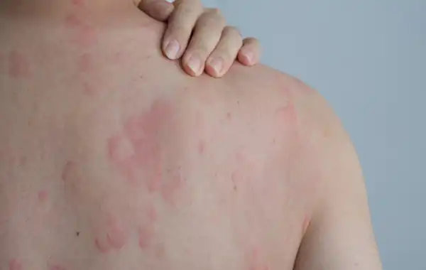 تعبیر خواب کهیر برای زن متاهل و باردار و دختر مجرد از روانشناسی