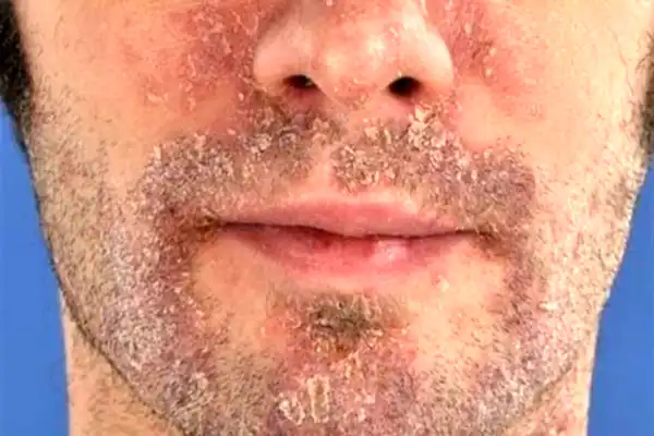 تعبیر خواب بیماری پوستی صورت برای زن متاهل و باردار و دختر مجرد از روانشناسی