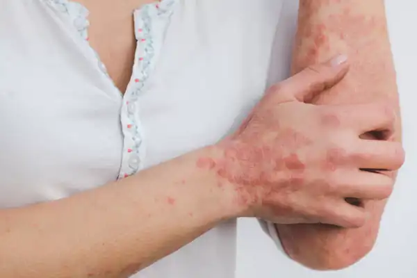 تعبیر خواب بیماری پوستی دست برای زن متاهل و باردار و دختر مجرد از روانشناسی