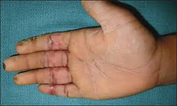 تعبیر خواب بریدن کف دست برای زن متاهل و باردار و دختر مجرد از روانشناسی