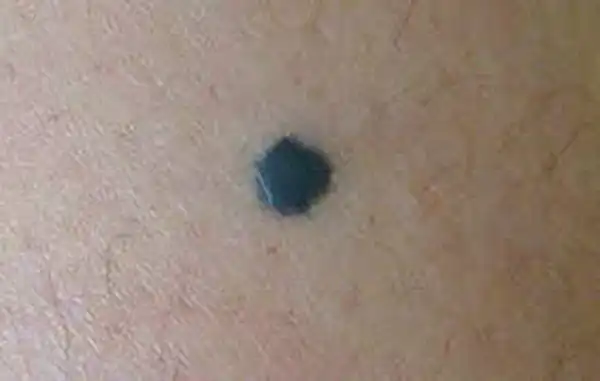 تعبیر خواب خال سیاه برای زن متاهل و باردار و دختر مجرد از روانشناسی