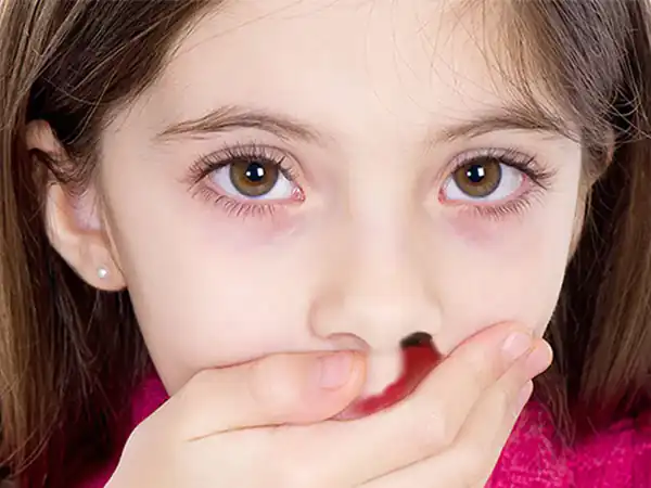تعبیر خواب خون دماغ شدن در خواب برای زن متاهل و باردار و دختر مجرد از روانشناسی