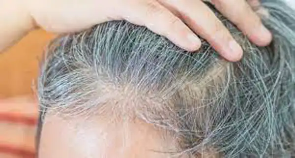 تعبیر خواب سفید شدن موی سر برای زن متاهل و باردار و دختر مجرد از روانشناسی
