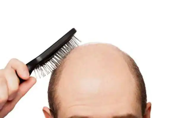 تعبیر خواب طاس شدن برای زن متاهل و باردار و دختر مجرد از روانشناسی