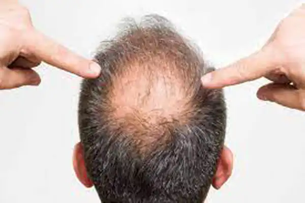 تعبیر خواب طاس شدن مو برای زن متاهل و باردار و دختر مجرد از روانشناسی