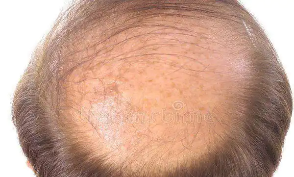 تعبیر خواب طاس شدن وسط سر برای زن متاهل و باردار و دختر مجرد از روانشناسی