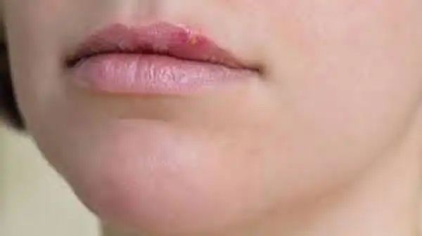 تعبیر خواب تبخال زدن صورت برای زن متاهل و باردار و دختر مجرد از روانشناسی