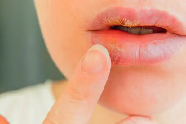 تعبیر خواب تبخال لب برای زن متاهل و باردار و دختر مجرد از روانشناسی