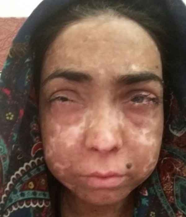 تعبیر خواب سوختن صورت خودم تعبیر خواب سوختن صورت دختر مجرد تعبیر خواب سوختن صورت فرزند تعبیر خواب سوختن دست و صورت دیگران تعبیر خواب سوختن پا و تاول زدن تعبیر خواب سوختن صورت همسر تعبیر خواب سوختگی بدن دیگران تعبیر خواب بدن سوخته مرده